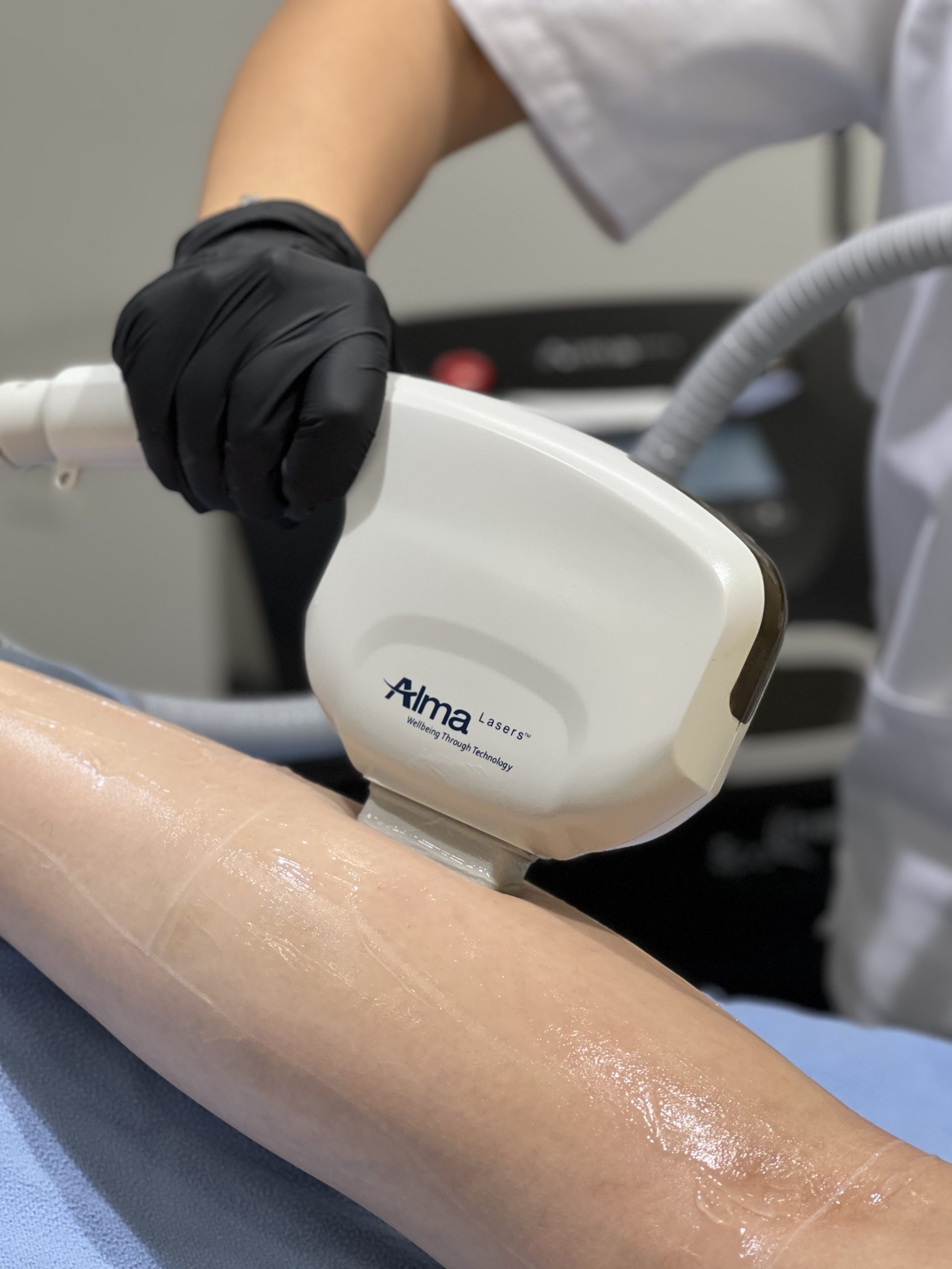 Wie dauerhafte Haarentfernung bei MediTeam Frauenfeld das Leben verändern kann
